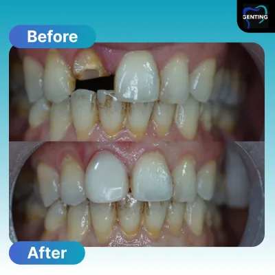 Before and after dental treatment at Klinik Pergigian Genting, Setapak - patient case 3