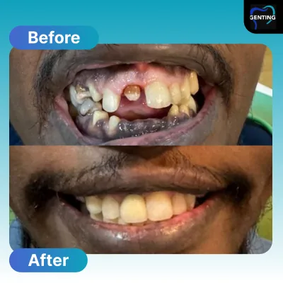 Before and after dental treatment at Klinik Pergigian Genting, Setapak - patient case 4