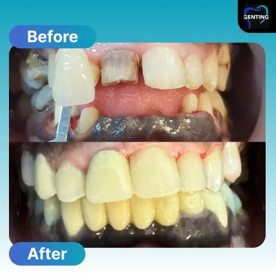 Before and after dental treatment at Klinik Pergigian Genting, Setapak - patient case 5