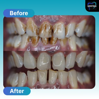 Before and after dental treatment at Klinik Pergigian Genting, Setapak - patient case 6