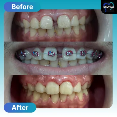 Before and after dental treatment at Klinik Pergigian Genting, Setapak - patient case 7
