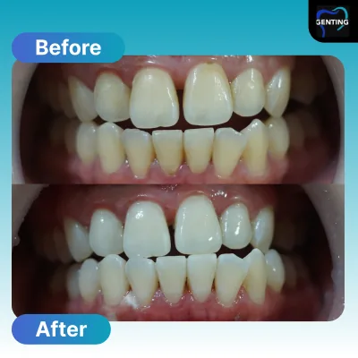 Before and after dental treatment at Klinik Pergigian Genting, Setapak - patient case 8