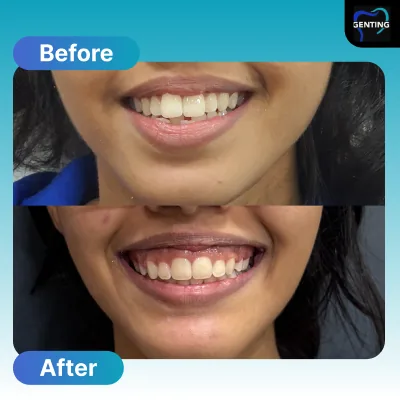 Before and after dental treatment at Klinik Pergigian Genting, Setapak - patient case 10