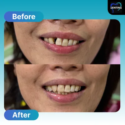 Before and after dental treatment at Klinik Pergigian Genting, Setapak - patient case 12