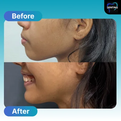 Before and after dental treatment at Klinik Pergigian Genting, Setapak - patient case 14