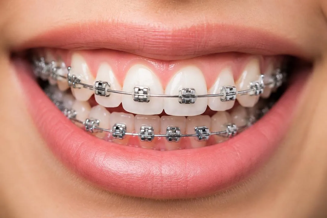 Rawatan braces di Klinik Pergigian Genting, Setapak
